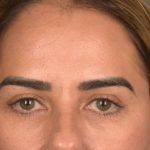 Brow Lift Before & After Patient #3300