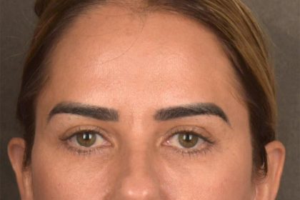 Brow Lift Before & After Patient #3300
