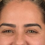 Brow Lift Before & After Patient #3300