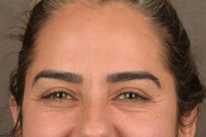 Brow Lift Before & After Patient #3300