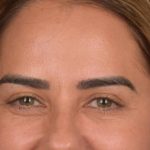Brow Lift Before & After Patient #3300