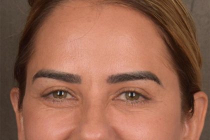Brow Lift Before & After Patient #3300