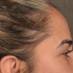 Brow Lift Before & After Patient #3300