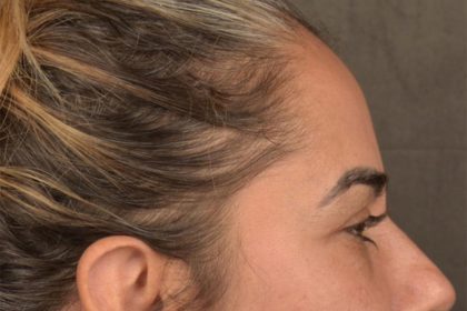 Brow Lift Before & After Patient #3300