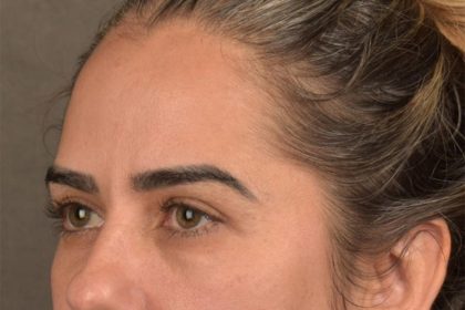 Brow Lift Before & After Patient #3300