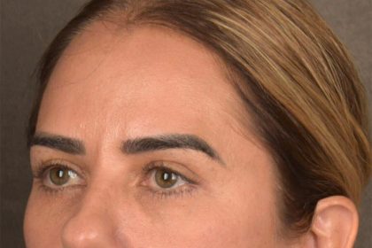 Brow Lift Before & After Patient #3300
