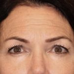 Facial Fat Grafting Before & After Patient #3301