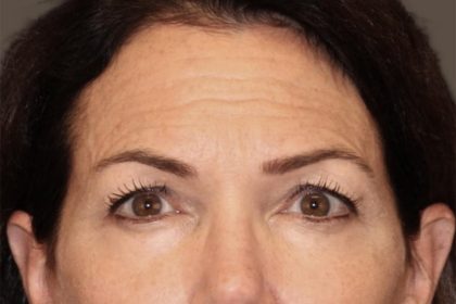 Facial Fat Grafting Before & After Patient #3301
