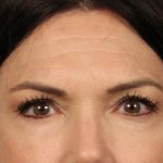 Facial Fat Grafting Before & After Patient #3301