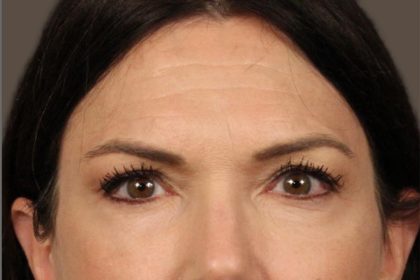 Facial Fat Grafting Before & After Patient #3301