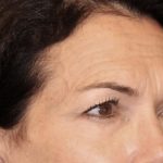 Facial Fat Grafting Before & After Patient #3301