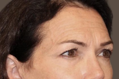 Facial Fat Grafting Before & After Patient #3301