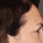 Facial Fat Grafting Before & After Patient #3301