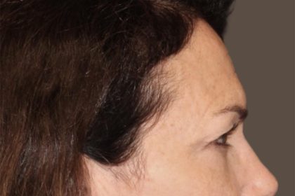 Facial Fat Grafting Before & After Patient #3301