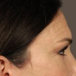 Facial Fat Grafting Before & After Patient #3301