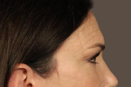Facial Fat Grafting Before & After Patient #3301