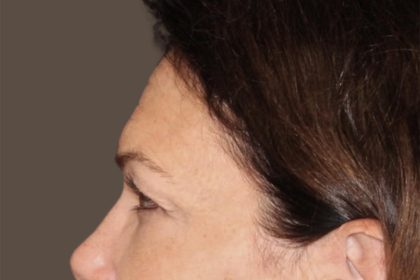 Facial Fat Grafting Before & After Patient #3301