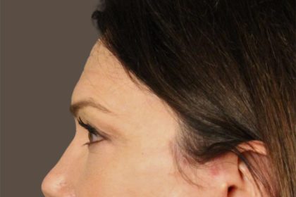 Facial Fat Grafting Before & After Patient #3301