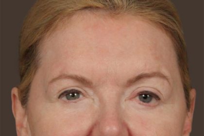 Brow Lift Before & After Patient #3302