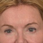 Brow Lift Before & After Patient #3302