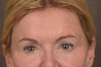 Brow Lift Before & After Patient #3302