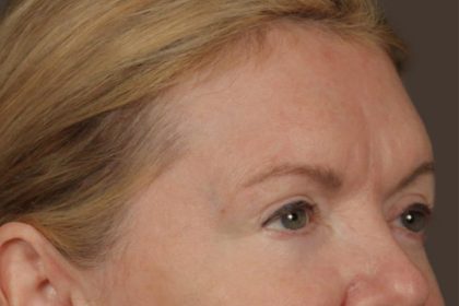 Brow Lift Before & After Patient #3302