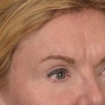 Brow Lift Before & After Patient #3302