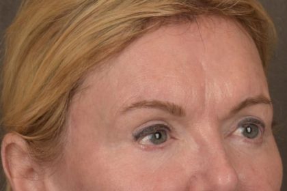 Brow Lift Before & After Patient #3302