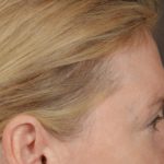 Brow Lift Before & After Patient #3302