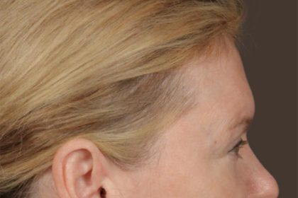 Brow Lift Before & After Patient #3302