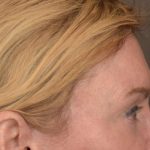 Brow Lift Before & After Patient #3302
