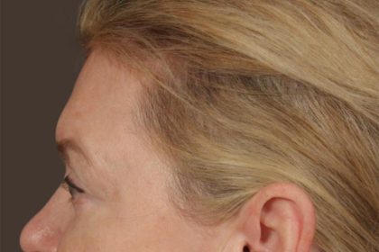 Brow Lift Before & After Patient #3302