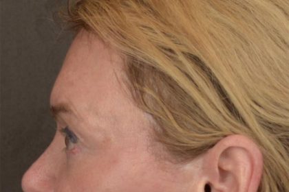 Brow Lift Before & After Patient #3302