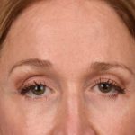 Brow Lift Before & After Patient #3290