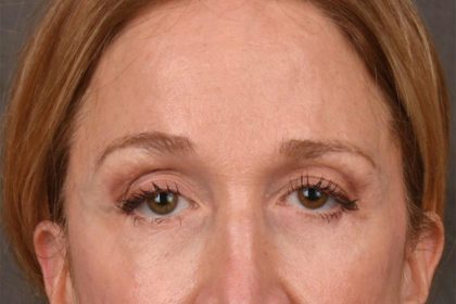 Brow Lift Before & After Patient #3290