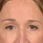 Brow Lift Before & After Patient #3290