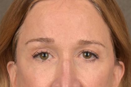 Brow Lift Before & After Patient #3290