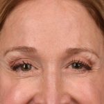 Brow Lift Before & After Patient #3290