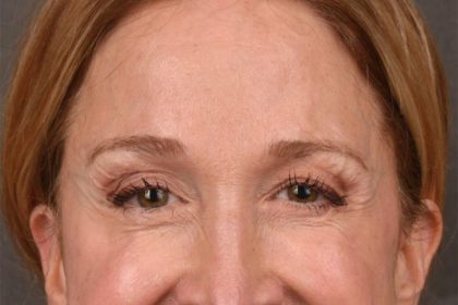 Brow Lift Before & After Patient #3290