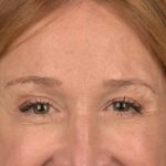 Brow Lift Before & After Patient #3290