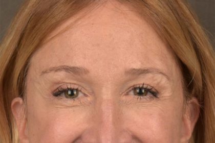 Brow Lift Before & After Patient #3290