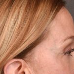 Brow Lift Before & After Patient #3290