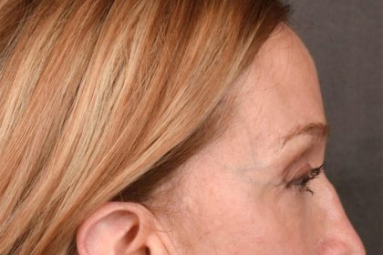 Brow Lift Before & After Patient #3290