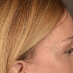 Brow Lift Before & After Patient #3290