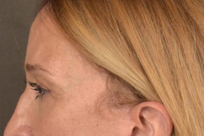 Brow Lift Before & After Patient #3290