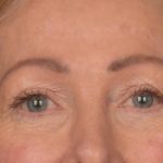 Blepharoplasty Before & After Patient #3124