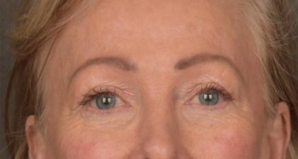 Blepharoplasty Before & After Patient #3124