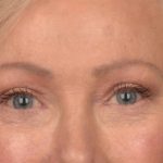 Blepharoplasty Before & After Patient #3124