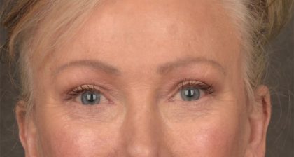 Blepharoplasty Before & After Patient #3124