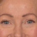 Blepharoplasty Before & After Patient #3124